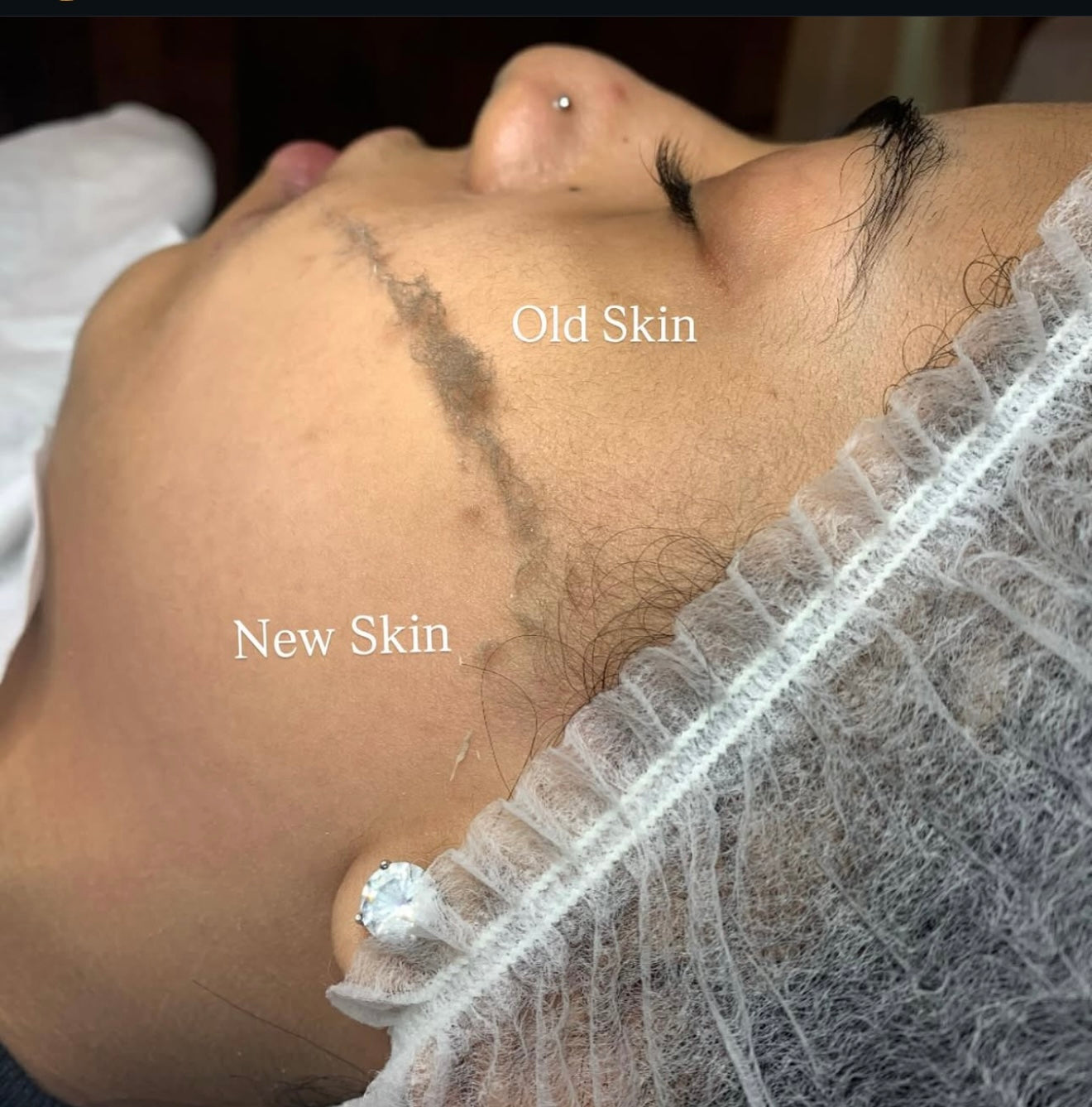 Dermaplaning Masterclass